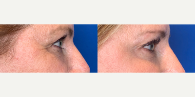 35-44 year old woman treated with Xeomin - Patient was concerned about crows feet around her eyes making her look older. Dr. Barbarino treated her with Xeomin, and two weeks later, appearance of crows feet greatly diminished. The patient is thrilled with the treatment.