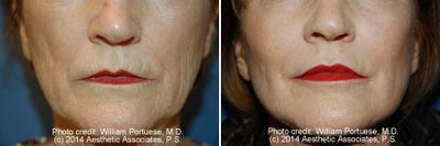 Dermabrasion - Dermabrasion