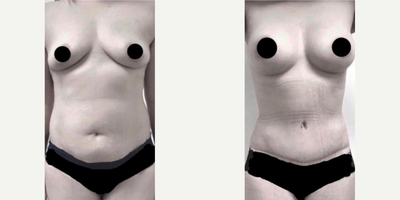 Woman treated with Breast Augmentation - Woman treated with Breast Augmentation as well as Tummy Tuck and Liposuction, shown 3 weeks post op.
