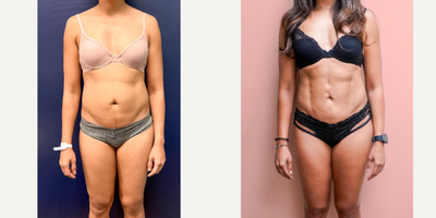 25-34 year old woman treated with Vaser Liposuction, Liposculpture, Abdominal Etching - This lovely out-of-state patient underwent liposuction by another surgeon on the West coast, but was unhappy with the result. She consulted with other providers but finally settled on having her surgery with me. She was already athletic but wanted to have definition to show the fruits of her hard work a little more, especially after her pregnancies. She is shown 1 year post-op from high-definition liposuction using Vaser to define her abdomen. She finally loves her results!