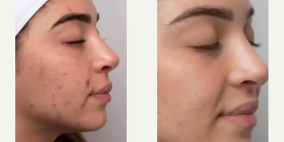 Woman treated with AviClear - My Aviclear results are here following my three sessions!If youve been following along, then you know Ive been struggling with acne over the past two yearsits no secret! Thats why I was so excited to find AviClear by cuterainc. Throughout the three treatments, I have seen such an improvement in my skins tone. Even better? Each session is only 30 minutes! You can treat mild, moderate, and severe acne with quick treatments that require no downtime.