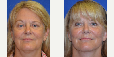 45-54 year old woman treated with Facial Fat Transfer - This patient came in wanting to look as young as she feels. Wanting a natural-looking result, she reached out to Dr. Ho for more information on how to improve her appearance. She elected to have a face/neck lift, fat transfer and laser skin resurfacing procedure.