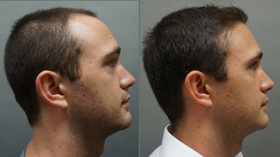 Man treated with Hair Transplant - Man treated with Hair Transplant
