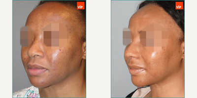 [African American Rhinoplasty] 100% Rib Cartilage Rhinoplasty - 100% Rib cartilage Rhinoplasty with Mid-face augmentation (Rib Cartilage)