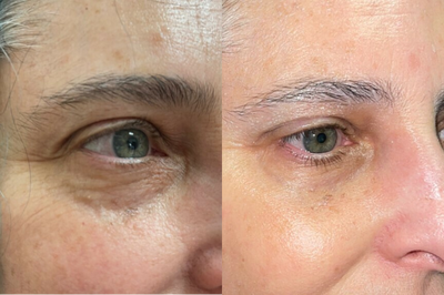 45-54 year old woman treated with Restylane - Mixto fractional Co2 laser resurfacing was combined with Ultherapy and estylane filler for what I call a liquid eyelit. No cutting was performed and healing time is about 5-7 days.