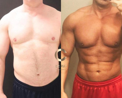 45-54 year old man treated with Abdominal Etching - 4d vaser liposuction on the abdomen, back, flanks, arms and chest performed