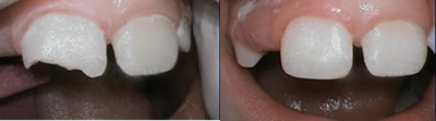 Filling to Repair Broken Tooth - 
	The patient's broken tooth was repaired with a filling.
