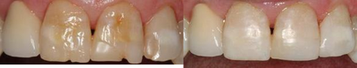 Fillings to Restore Chipped Teeth - 
	The patient had chips on the bottom of his anterior teeth. Although the patient did not choose to restore the teeth with crowns, veneers, or bleaching, he did choose to have the chips repaired with dental bonding.
