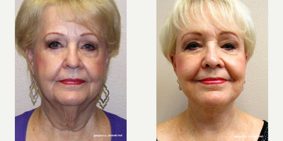 Woman treated with Facelift, QuickLift - Woman treated with Facelift, QuickLift