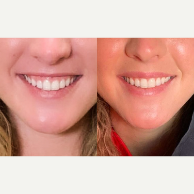25-34 year old woman treated with Botox for Gummy Smile - This 26 year old bride - to - be wanted to slowly ease into fixing her gummy smile before her wedding.