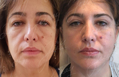 45 - 54 year old woman treated with Facelift - facelift