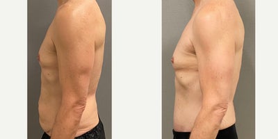 55-64 year old man treated with Male Tummy Tuck - 56 yo male s/p abdominoplasty without muscle tightening performed in our on site AAAA certified operating suite.