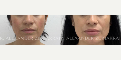 35 year old woman treated with Facial Fat Transfer - 35 year old woman treated with Facial Fat Transfer