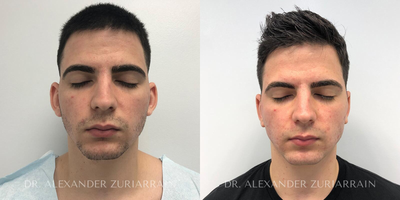 Man treated with Ear Surgery - Man treated with Ear Surgery