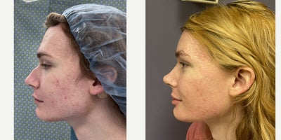 18-24 year old woman treated with Adam's Apple Reduction, Brow Bone Reduction, Brow Lift, Facial Feminization Surgery, Forehead - This is a young lady who underwent forehead feminization, septorhinoplasty, and chin feminization.