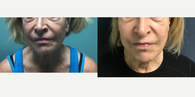 45-54 year old woman treated with Pelleve - Before and after 3 pelleve treatments.