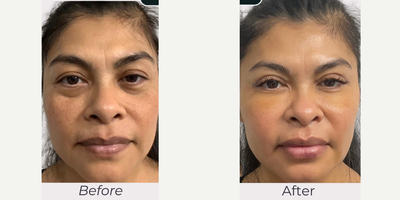 45-54 year old woman treated with Chin Filler, Cheek Fillers, CO2 Laser, Radiesse, Belotero - Patient had dermal fillers done radiesse in her cheek, belotero for her under eye. Co2 fractional laser 1 week after