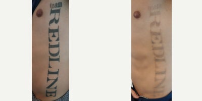 35-44 year old man treated with Tattoo Removal - Laser tattoo removal after only 3 sessions. Following the procedures, the patient experienced remarkable improvements in their tattoo fading. Laser Tattoo Removal is performed with a Spectra Q Switch Laser.