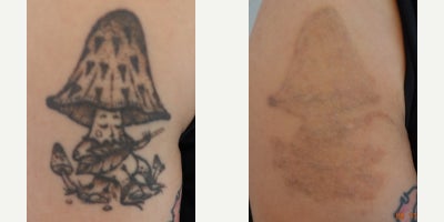 25-34 year old man treated with Tattoo Removal - Laser tattoo removal of mushroom after 12 sessions. Following the procedures, the patient experienced remarkable improvements in their tattoo fading. Laser Tattoo Removal is performed with a Spectra Q Switch Laser.