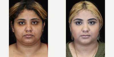 25-34 year old woman treated with PrecisionTx - My beautiful young patient was unhappy with her submental fullness - the extra fat under her chin. To achieve the contoured look she desired, I performed a LaserLift with Precision Tx. During this procedure, I make tiny incisions under each earlobe and chin where I insert a tiny LASER probe. The laser energy emulsifies unwanted fat under the skin through laser lipolysis. The liquid fat is then gently suctioned out, contouring the neck an jawline with precision!To learn more about LaserLift with Precision Tx, contact my office.