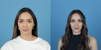 25-34 year old woman treated with Revision Rhinoplasty - Revision Rhinoplasty, breathing problems fixed, nose hump removed, nose tip corrected and elevated