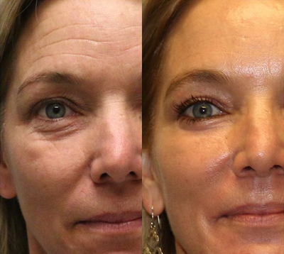 Woman treated with Skin Rejuvenation - Woman treated with Skin Rejuvenation through laser resurfacing as well as upper and lower eyelid blepharoplasty. Patient was concerned with her tired appearing eyes and wanted an overall refresh. She displayed festoons, the lower eyelid pockets, that are difficult to treat with lasers or surgery alone.