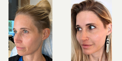 THE MAGNIFICENT MIRACU MAKEOVER - Our patient has come in for several treatments, but the headliner is the MIRACU MAKEOVER. She wants threads for her mid and lower face in order to contour her cheeks and jawline. She has been following our social media for years and has seen the spectacular results we've managed to achieve with threads before and wanted that for herself. Immediately after, she looks much more swollen and inflamed than she otherwise would have due to the other treatments she had in addition to threads. Regardless, once she was all healed up, she absolutely loved the contouring the threads gave her.WHY WE CHOOSE MIRACUThe best part about the @miracupdothreads is that they pack the strongest hold. The conical barbs grip onto the tissue and they don't let go. This is amazing, but it is also why it is so important to go to an experienced provider such as ourselves. Once the threads are in, they aren't going anywhere, so you'd be best served to go to the best.THIRSTING FOR THREADS? WE'VE GOT YOU COVERED 