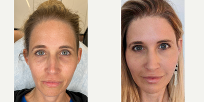 THE MAGNIFICENT MIRACU MAKEOVER - Our patient has come in for several treatments, but the headliner is the MIRACU MAKEOVER. She wants threads for her mid and lower face in order to contour her cheeks and jawline. She has been following our social media for years and has seen the spectacular results we've managed to achieve with threads before and wanted that for herself. Immediately after, she looks much more swollen and inflamed than she otherwise would have due to the other treatments she had in addition to threads. Regardless, once she was all healed up, she absolutely loved the contouring the threads gave her.WHY WE CHOOSE MIRACUThe best part about the @miracupdothreads is that they pack the strongest hold. The conical barbs grip onto the tissue and they don't let go. This is amazing, but it is also why it is so important to go to an experienced provider such as ourselves. Once the threads are in, they aren't going anywhere, so you'd be best served to go to the best.THIRSTING FOR THREADS? WE'VE GOT YOU COVERED 