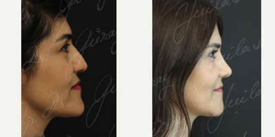 25-34 year old woman treated with Chin Implant, Jaw Reduction, Rhinoplasty - 25-34 year old woman treated with Chin Implant, Jaw Reduction, Rhinoplasty