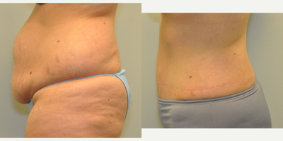 40 year old woman treated with Tummy Tuck - 40 year old female one year following a Tummy Tuck with repair of her muscle separation, using a drainless technique and a great reduction with a Galaflex internal support.
