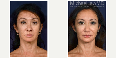 45-54 year old woman treated with Microneedling - Microneedling treatment.