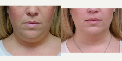 35-44 year old woman treated with 1 CoolSculpting treatment - Pt treated with Coolmini to submental area.
