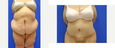 Body Lift  (front view) - Body Lift
