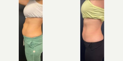 35-44 year old woman treated with Evolve, Semaglutide - Evolve body treatment with semaglutide combination for muscle tone - treated by Alyssa G