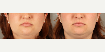 Masseter Botox (Non-Surgical Jawline Slimming) - 27-year-old female with a history of jaw grinding and clenching, facial pain and enlarged chewing muscles causing jaw widening. She is shown 6 weeks after neurotoxin (Botox) treatment to masseter muscles, resulting in jawline slimming and significant reduction in symptoms.