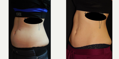 25-34 year old woman treated with CoolSculpting, CoolSculpting Elite - 25-34 year old woman treated with CoolSculpting, 3 months post-op
