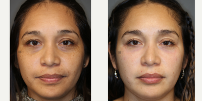Syringoma Laser Treatment and Lower Lid Filler - Lower eyelid bumps (syringomas) and full facial laser with lower lid filler.