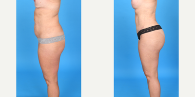 35-44 year old woman treated with Body Lift, Brazilian Butt Lift, Brazilian Butt Lift Revision, Butt Augmentation, Butt Lift, La - Before and after skinny BBL as part of a mommy makeover: Breast augmentation, tummy tuck, and BBL. We added 500cc pure fat to each butt to give a better shape and size. I call this a skinny BBL as the goal is always a perfect shape and not necessarily maximum volume.