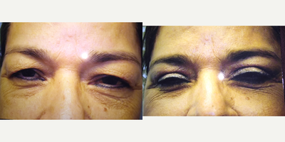 upper and lower eye lid surgery - upper and lower eye lid surgery