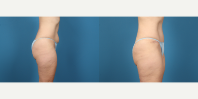 45-54 year old woman treated with Tummy Tuck, Liposuction - Abdominoplasty with suction assisted lipectomy of bilateral hips.