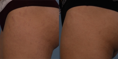 18-24 year old woman treated with Lux 1540 - Before: Darkened stretch marks on buttock after weight loss.After: Post 3 ICON Frax 1540 non ablative laser treatments. Note evening out of skin color and reduction in the stretch marks as a result of new collagen stimulation. The Frax 1540 is the first laser to receive FDA approval for the treatment of stretch marks.