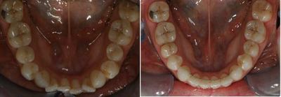 Orthodontic treatment without extraction of teeth - I have severe dental crowding and I would like to fix my teeth I would like to avoid extraction of teeth, if possible