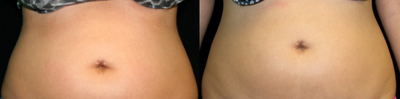 35-44 year old woman treated with UltraShape - 2 weeks after 1 UltraShape treatment.