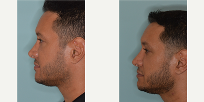 25-34 year old man treated with Revision Rhinoplasty - Male revision rhinoplasty patient who desired correction to his nose after two previous rhinoplasties.  He was bothered by the pinched and asymmetric appearance to the tip of his nose and the upturned appearance to the nose on the profile.  Revision rhinoplasty techniques included rib cartilage harvest for correction of the pinched tip and the counterrotation of the nose from the profile to provide for a straighter appearance to the nose.