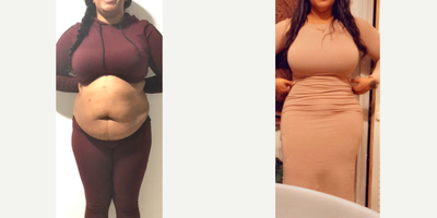 35-44 year old woman treated with Tummy Tuck, Liposuction, Brazilian Butt Lift - Excellent outcome after full tummy tuck combined with intense liposuction including abdomen, waist, laterals and upper and lower back to improve your body contour and get better curves, especially in your waist area and dominican butt lift.