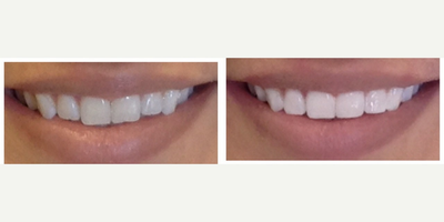 25-34 year old woman treated with Dental Bonding - Patients chief complaint was minor chipping and unevenness of smile. She also wanted a brighter smile. This is a combination of whitening, and bonding and recontouring where we add bonding material to some areas and recontour other areas to get a beautiful natural result. It is one of the most conservative procedures one can do for an improvement.