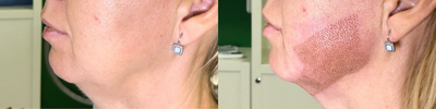 45-54 year old woman treated with Laser Treatment - Plasma Fibroblast Jowls