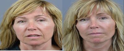 45-54 year old woman treated with Voluma - Botox to Crow's Feet, Juvederm Ultra XC to Nasolabial fold and VOLUMA to left and right cheeks