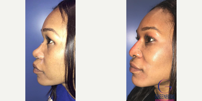 Woman treated with Nonsurgical Nose Job - Woman treated with Nonsurgical Nose Job using fillers to restore nasal bridge to achieve the look she wanted