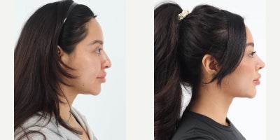 25-34 year old woman treated with Rhinoplasty - 27 year old 1 month after primary Rhinoplasty by Dr. Robert Chouake.